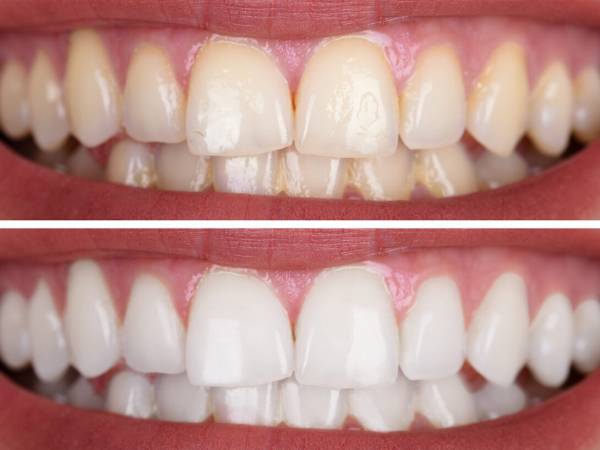 Before and After Dental Treatment Results at Aire Dental Group in Downers Grove, IL