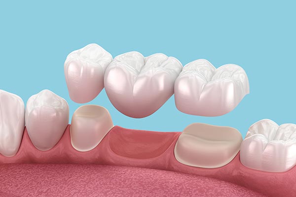Porcelain Crowns and Fixed Bridges in Downers Grove, IL Porcelain Crowns and Fixed Bridges in Downers Grove, IL