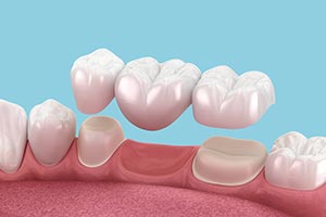 Porcelain Crowns and Fixed Bridges in Downers Grove, IL Porcelain Crowns and Fixed Bridges in Downers Grove, IL