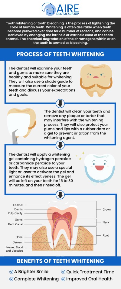 Common questions asked by patients: How does the GLO whitening work? What makes GLO whitening different from other teeth whitening treatments? Is GLO whitening safe for teeth and gums? How long does a GLO whitening treatment take? For more information, contact us or request an appointment online. We serve patients from Downers Grove IL, Westmont IL, Lisle IL, Woodridge IL, Darien, IL, Hinsdale, IL and surrounding areas. Common questions asked by patients: How does the GLO whitening work? What makes GLO whitening different from other teeth whitening treatments? Is GLO whitening safe for teeth and gums? How long does a GLO whitening treatment take? For more information, contact us or request an appointment online. We serve patients from Downers Grove IL, Westmont IL, Lisle IL, Woodridge IL, Darien, IL, Hinsdale, IL and surrounding areas.